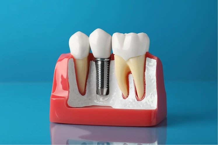 Dental Implants