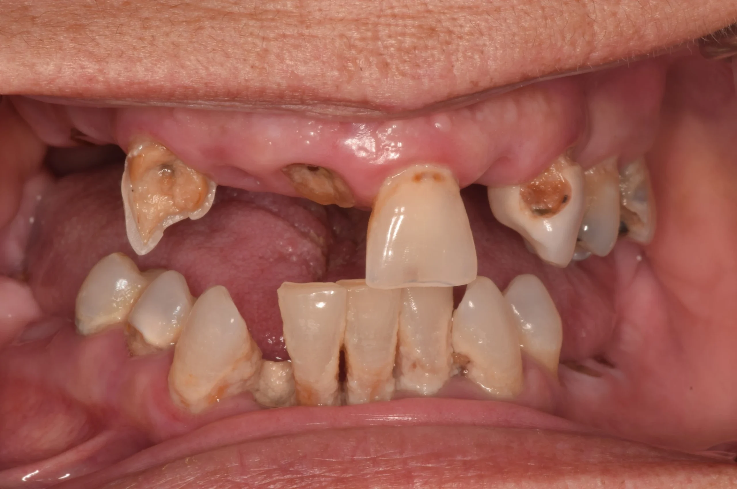 misaligned discolored teeth before treatment