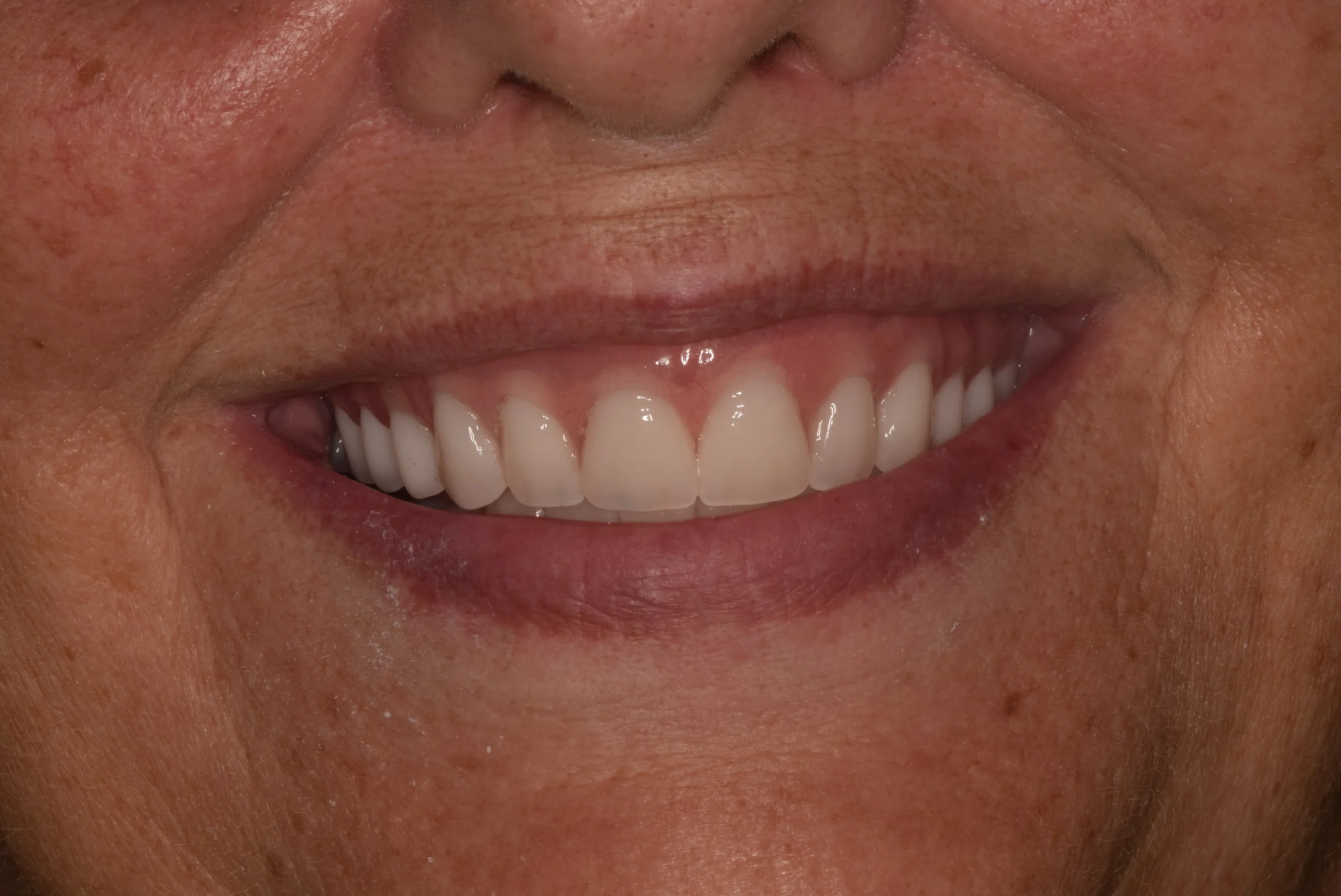 straight brightened teeth after treatment