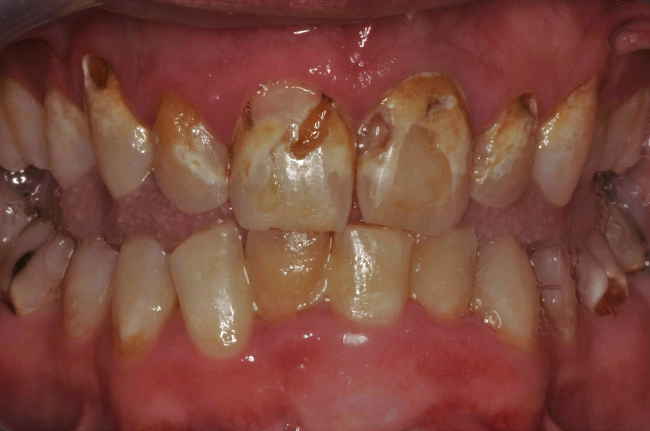 misaligned discolored teeth before treatment