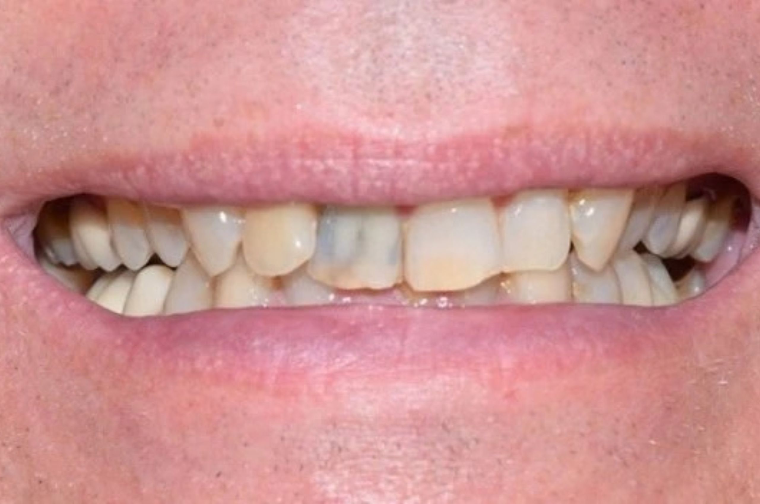 misaligned discolored teeth before treatment