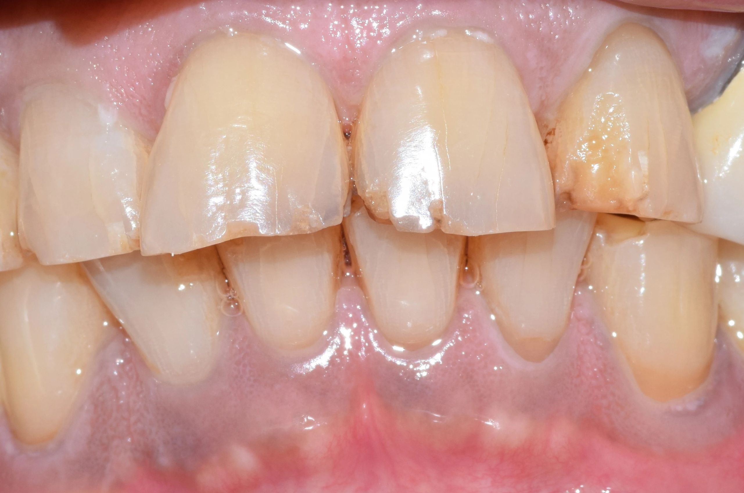 misaligned discolored teeth before treatment