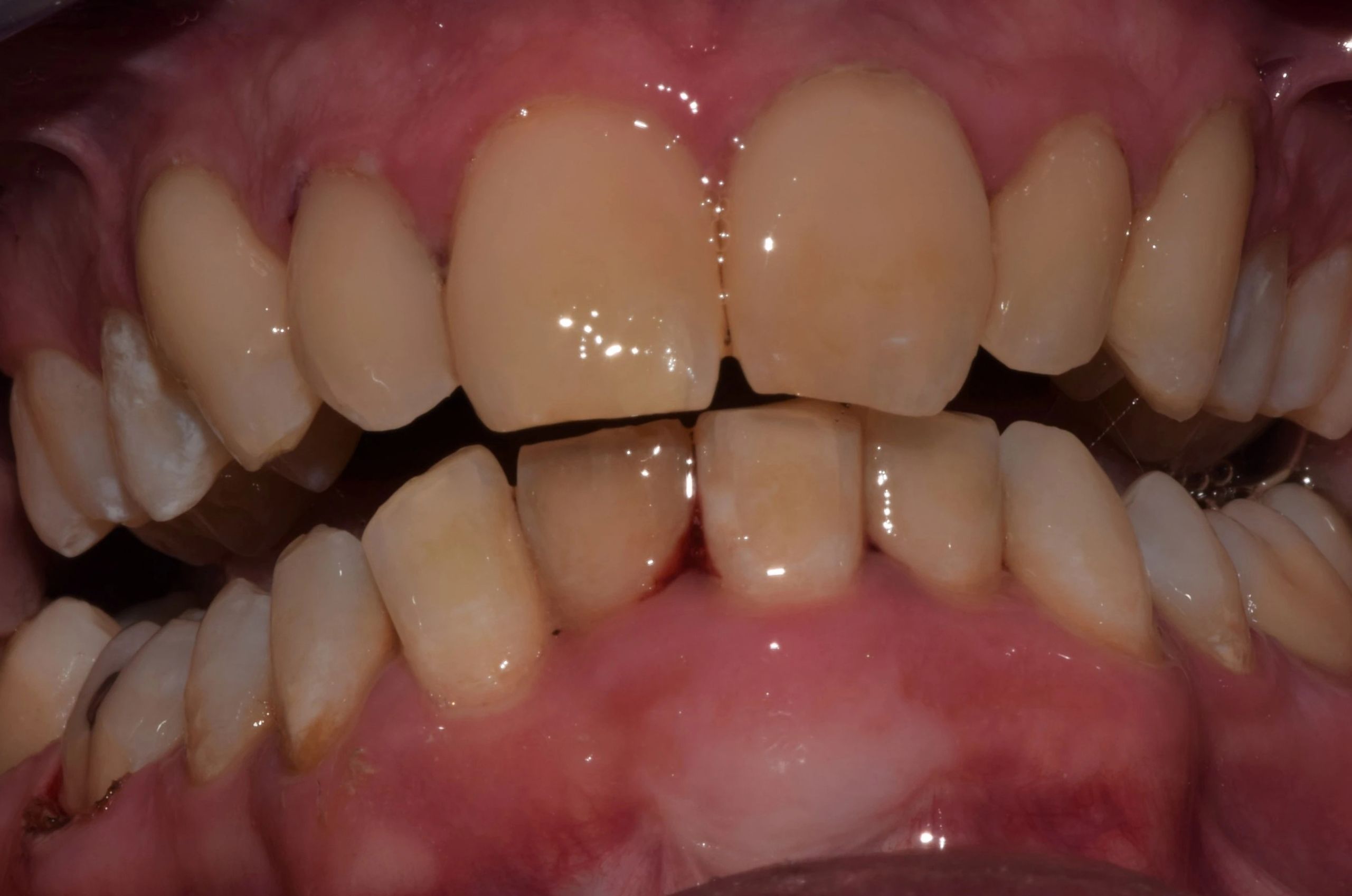 straight brightened teeth after treatment