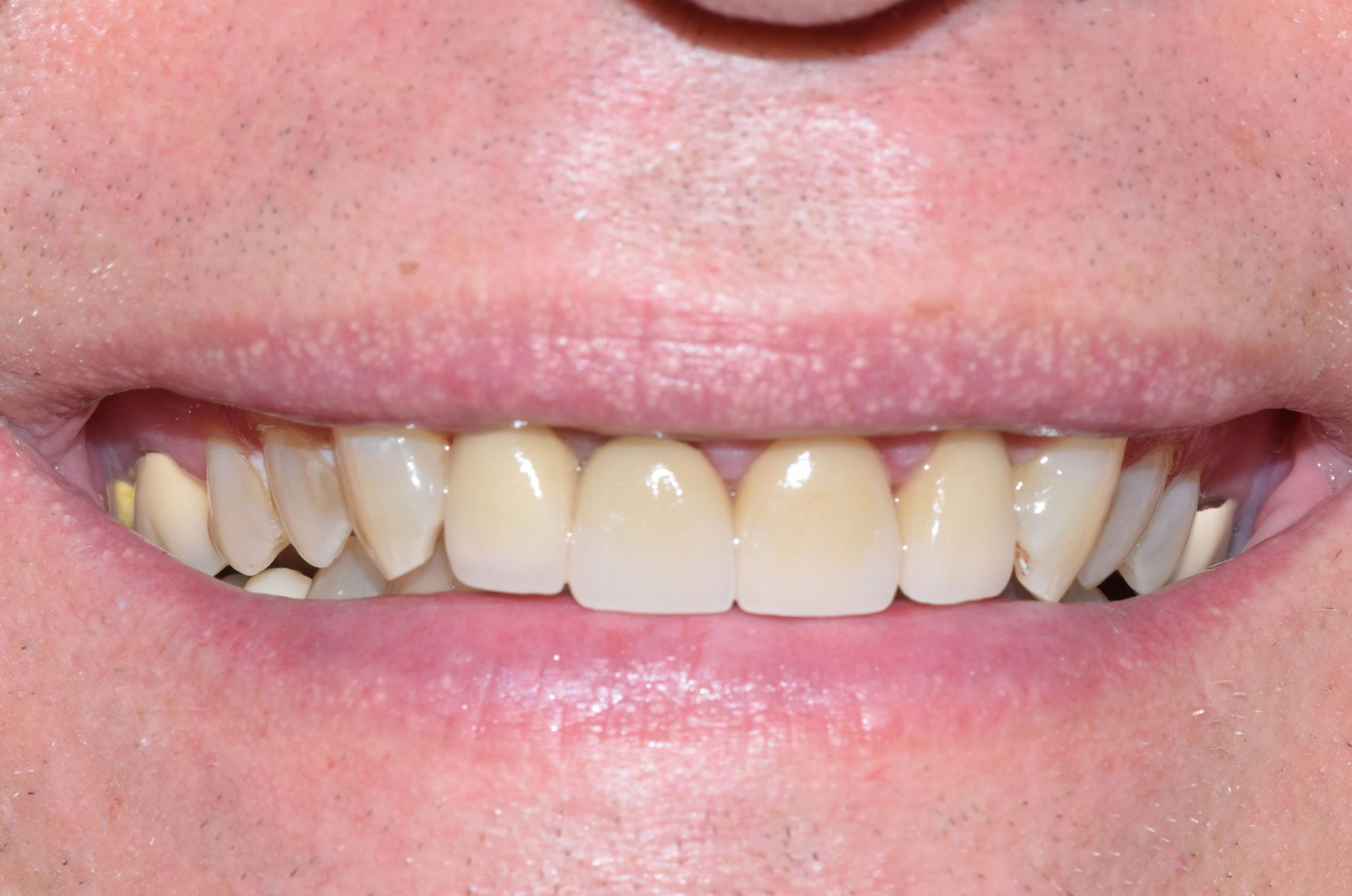 straight brightened teeth after treatment
