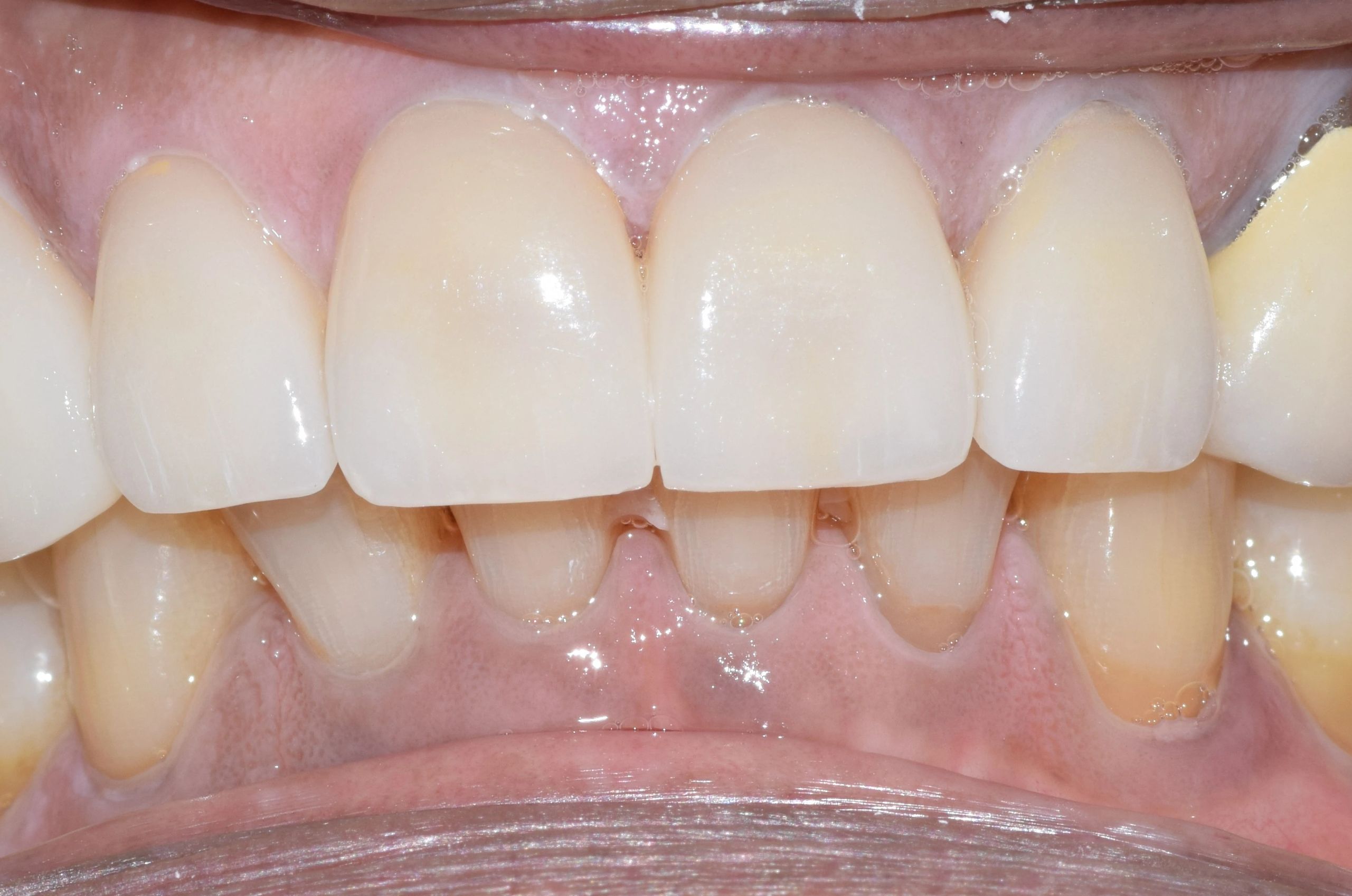 straight brightened teeth after treatment