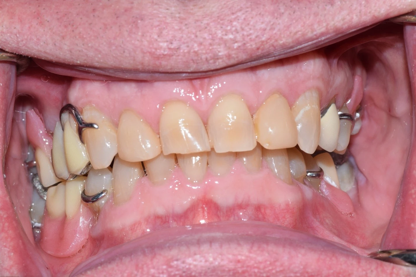 straight brightened teeth after treatment