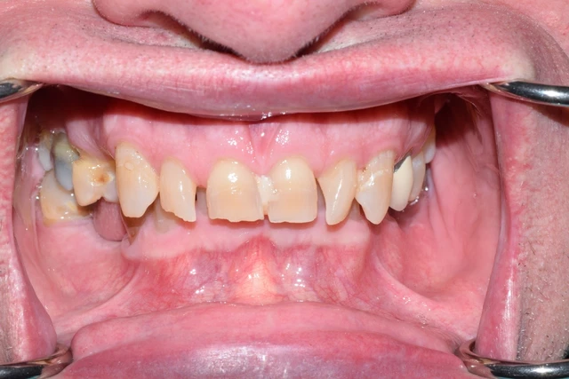 misaligned discolored teeth before treatment